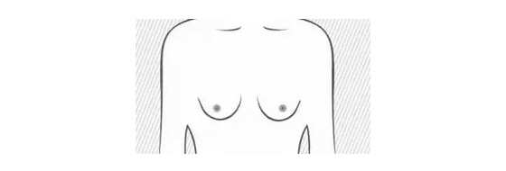 乳房下垂做假体隆胸效果怎么样