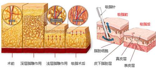 沈阳做大腿吸脂对身体会不会有影响