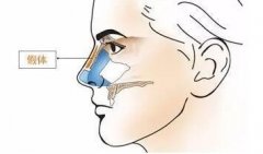 沈阳做膨体隆鼻失败后要注意哪些方面