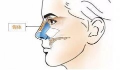 广州膨体隆鼻修复术后应该注意哪些