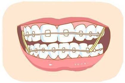 牙齿矫正