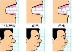 广州矫正牙齿好处有几个方面呢