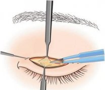 广州上睑下垂矫正需要多少钱呢