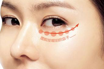 石家庄手术祛眼袋可以保持多长时间