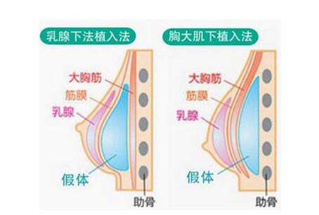 宁波假体隆胸效果怎么样