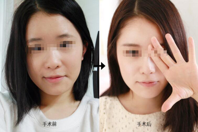 南京假体隆鼻手术后的护理小常识