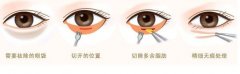 武汉祛眼袋手术恢复期会影响工作吗