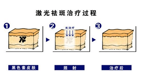 激光祛斑的价格