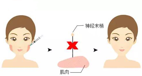 成都瘦脸的效果能够维持多长时间