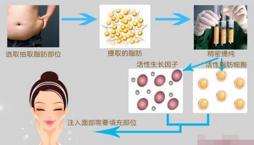 自体脂肪填充面部的效果会消失吗