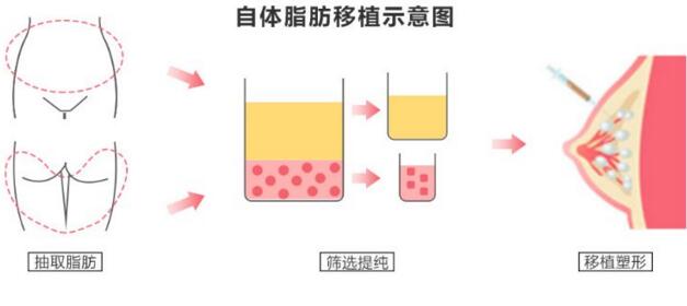 自体脂肪丰胸多久可以稳定下来