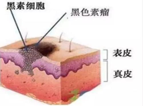 激光祛斑价格