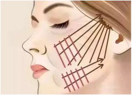 面部埋线提升的效果可以保持多少年