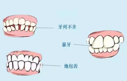 上海做牙齿畸形矫正多少钱