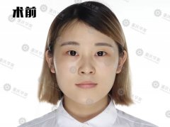 重庆华美双眼皮大挑战，术后半个月到底能不能被发现是割的？