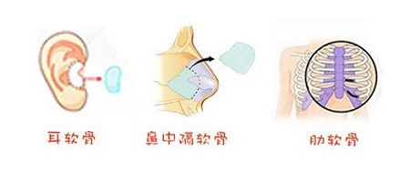 自体软骨隆鼻的潜在风险