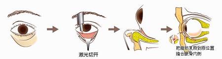 激光去眼袋手术