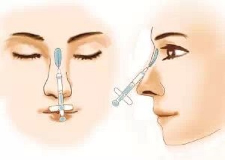 注射玻尿酸隆鼻术