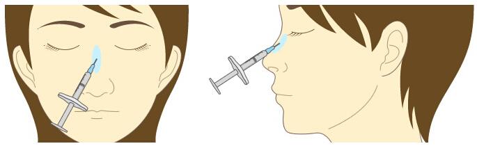 韩式假体隆鼻手术