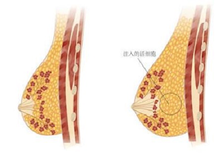 做自体脂肪丰胸手术