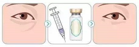 玻尿酸丰泪沟有什么优势