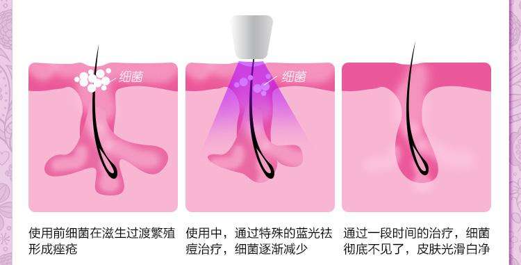北京彩光嫩肤祛痘印一般要多少钱