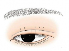 厦门割双眼皮术后的疤痕能自然退掉么