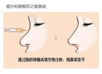 武汉注射玻尿酸隆鼻有效果要多久？