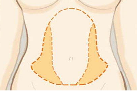 腹部吸脂
