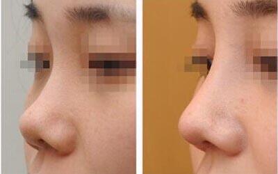 假体隆鼻术前有什么注意事项？