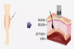 重庆做大腿抽脂手术后护理措施有哪些