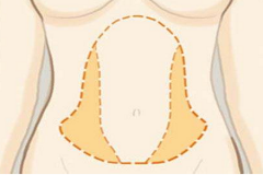 上海做腹部吸脂术后要注意哪些呢
