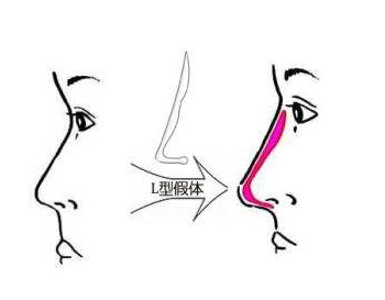 北京假体隆鼻常用的手术材料哪些