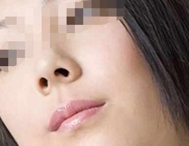 矫正鼻孔大的手术会留疤吗？