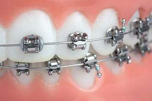 牙齿校正的方法有哪些？