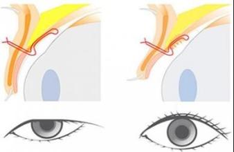 上睑下垂矫正手术