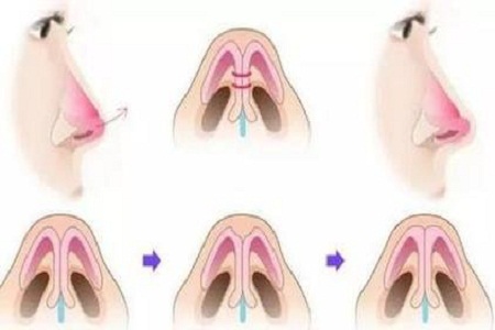 玻尿酸隆鼻