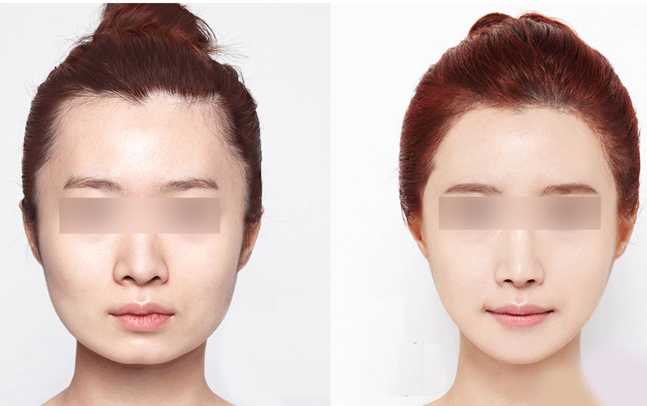 瘦脸效果能维持多久？