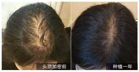 头发种植后怎么护理？