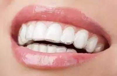 牙齿矫正有哪些注意事项？