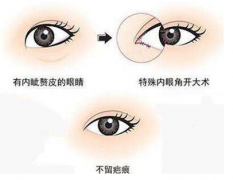 北京做双眼皮手术一定要开眼角吗