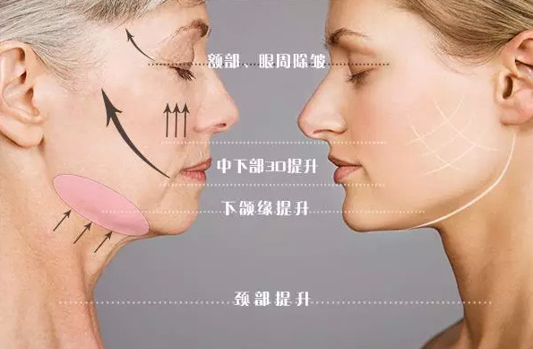 天津脸部做埋线提升后遗症有什么？