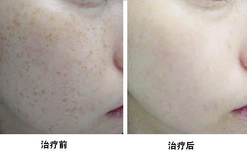 南京治疗脸部黄褐斑的价钱一般是多少