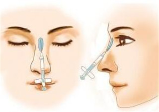 玻尿酸注射隆鼻