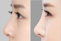 自体隆鼻的优势有哪些了解吗
