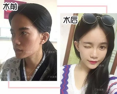 脂肪填一填，脸竟从“丧到爆”变“萌出血”！