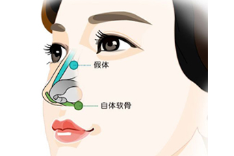 杭州整鼻子一般需要多少钱呢？