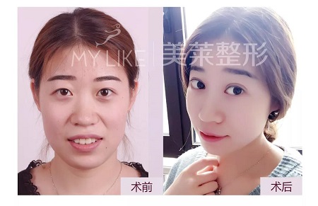 美莱特邀整形医师—卜胜利主任，