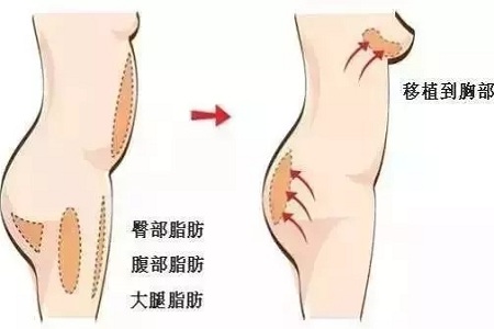 自体脂肪隆胸 vs 假体隆胸，该怎么选？哪个更好更安全？