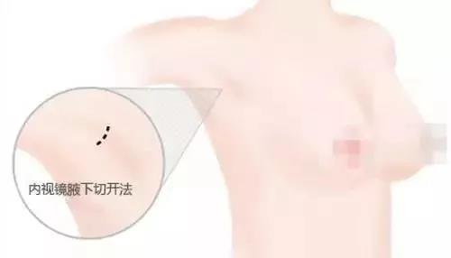科普|假体隆胸的三种切口，该如何选择